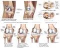 Common Knee Injuries
