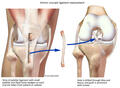 Human Knee - Torn ACL Repair