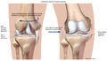 Common Injuries of the Human Knee