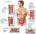 Organic Bowel Diseases