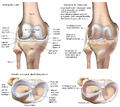 Osteoarthritis of the Knee