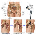 Osteoporosis of the Hip