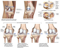 Common Knee Injuries