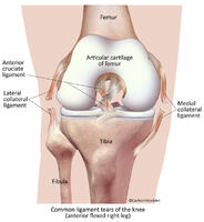 Torn Ligaments of the Human Knee - Anterior View