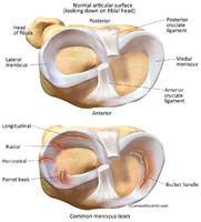 Human Knee - Torn  Meniscus