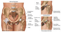 Osteoarthritis and Rheumatoid Arthritis of the Hip