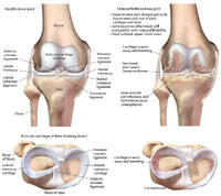 Osteoarthritis of the Knee