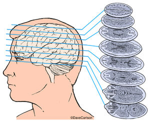 CT - Computed Tomography - Brain Scan