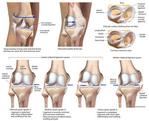 Stock illustration of common knee injuries including ligament and meniscus tears and sprains