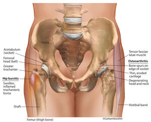 Bursitis and Osteoarthritis of the Hip