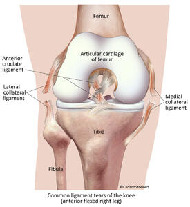 Torn Ligaments of the Human Knee - Anterior View