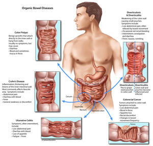 Organic Bowel Diseases