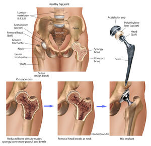 Osteoporosis of the Hip