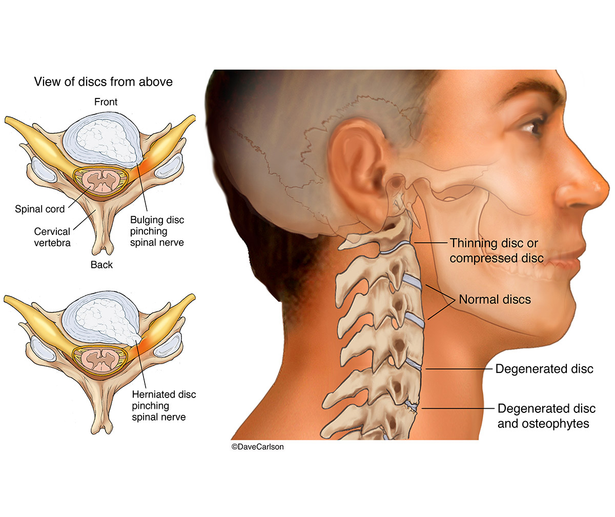 Illustration showing common cervical spine and disc problems.