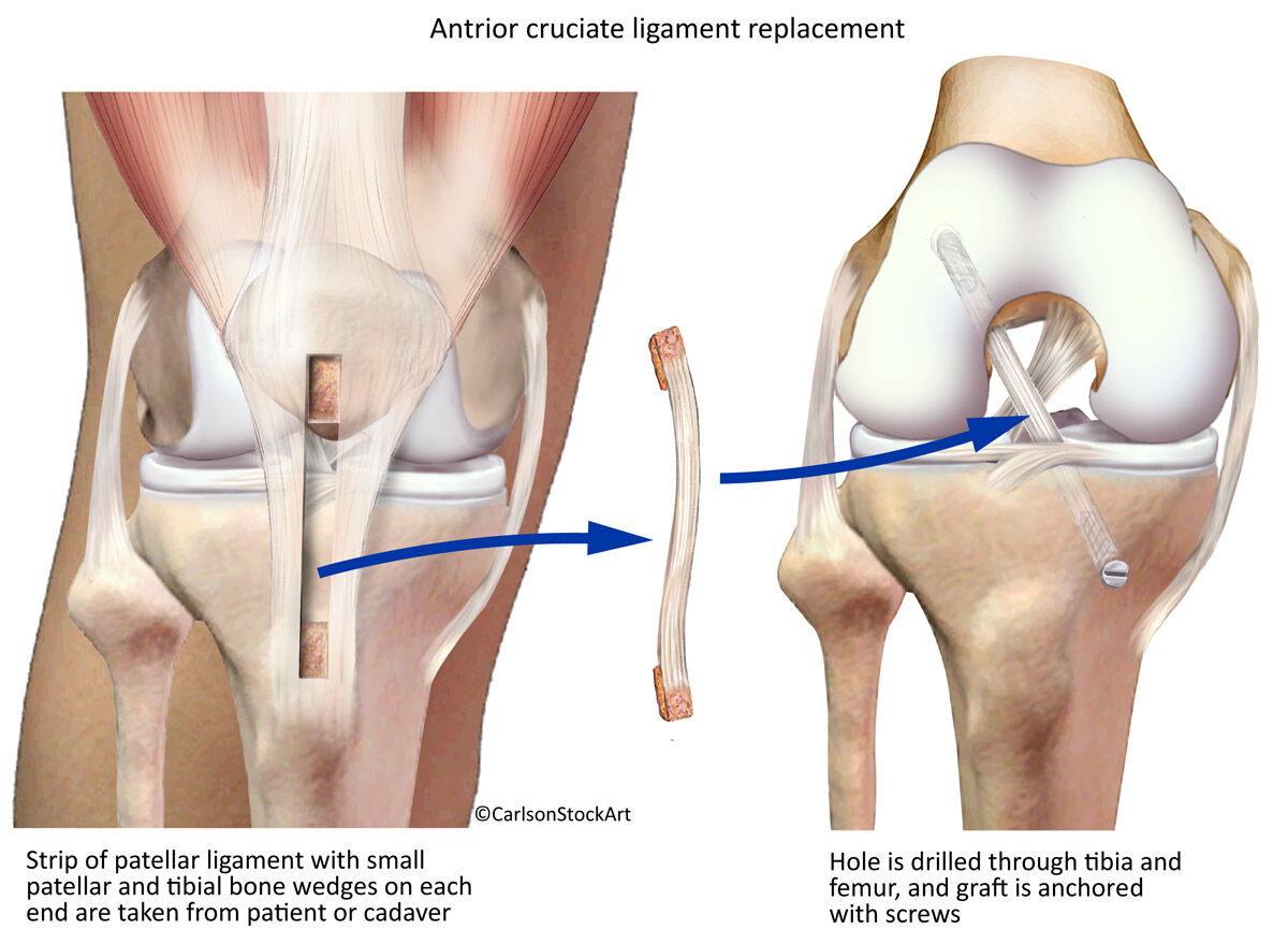 Illustration showing a common technique for the repair of a torn anterior cruciate ligament.