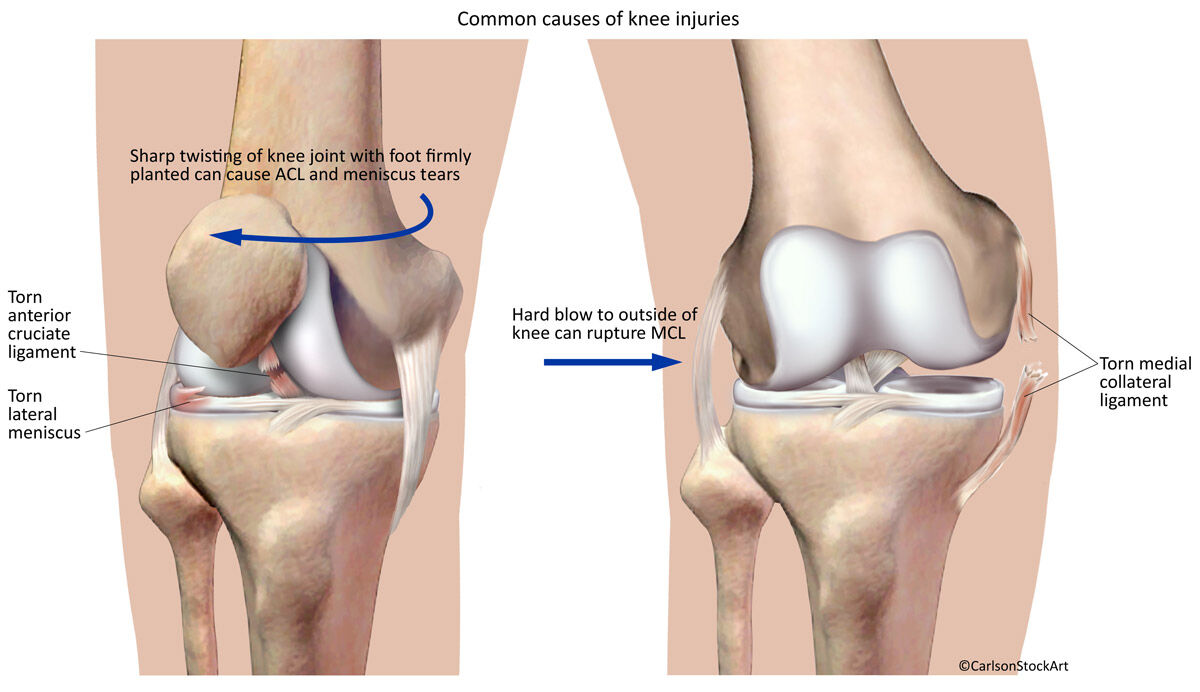 Illustration showing the causes of the three most common types of knee injuries, including torn ACL (anterior cruciate ligament...